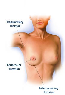 OP-Techniken der Brustvergrößerung