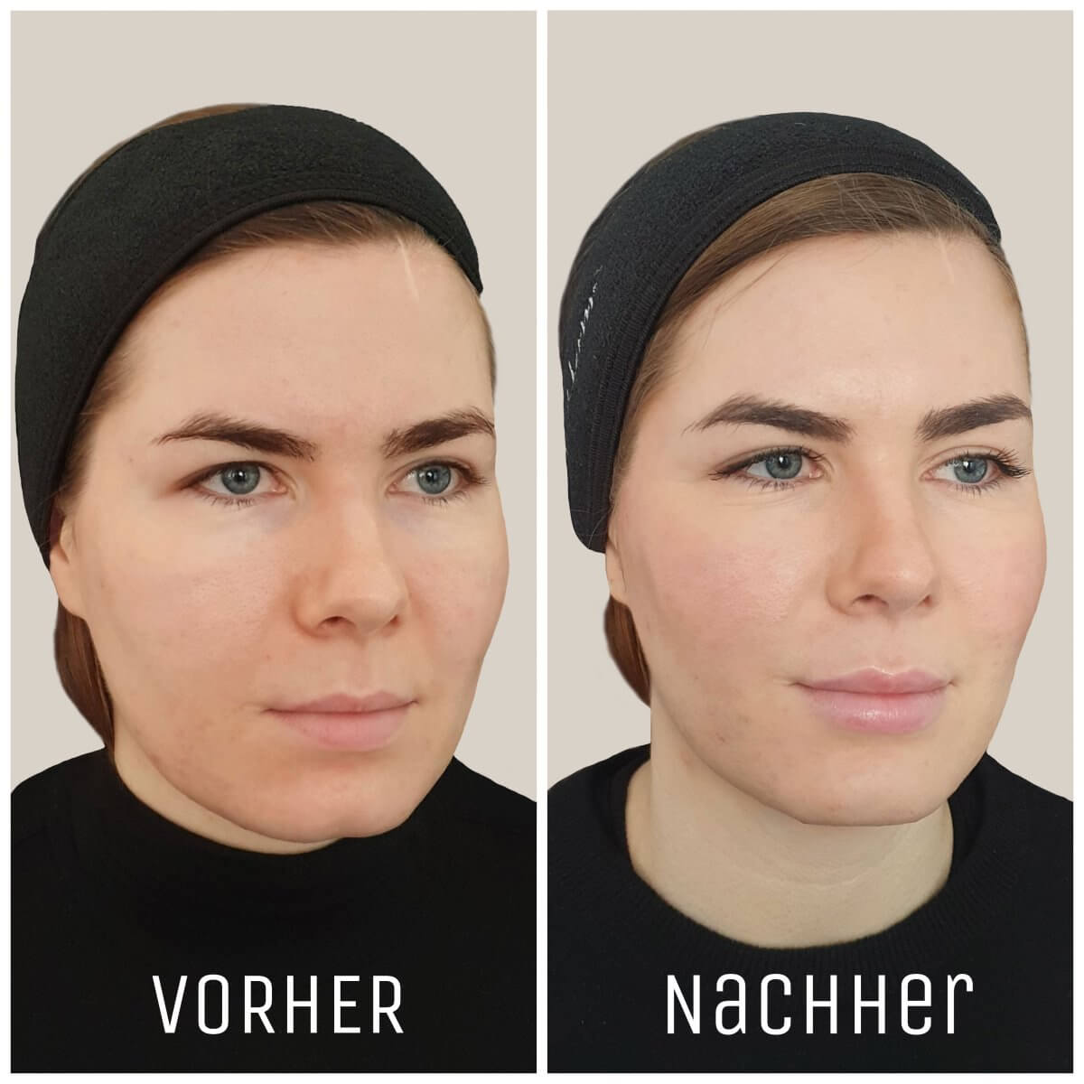 Russian Lips Technik – Vorher-Nachher-Bild